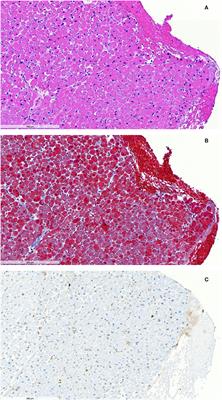 Case Report: Steroid-Responsive Takotsubo Cardiomyopathy Associated With Cytokine Storm and Obstructive Shock